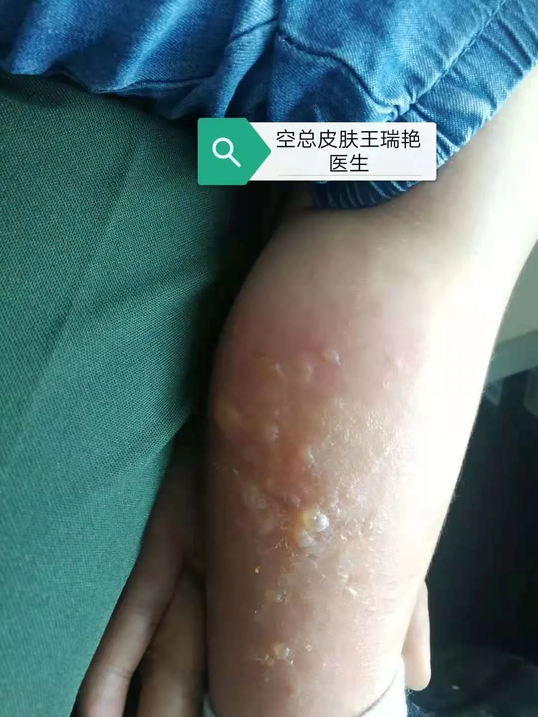 皮肤科亲历河南水灾的我提醒大家小心这些皮肤病