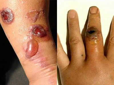 炭疽的症状和治疗: 皮肤炭疽:可发生痈,恶性水肿两型.