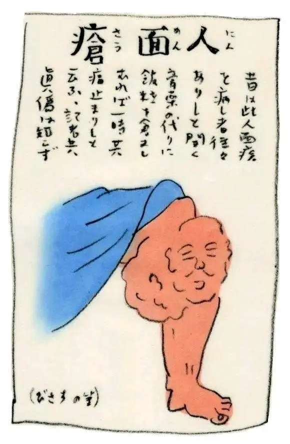 人面疮这种病症自古以来都是奇病，人面疮，一种是活的，一种是死的。而