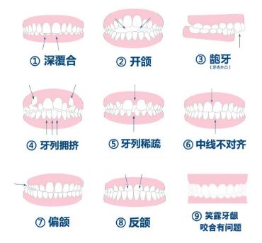 东莞东城儿童牙齿矫正的那些事情,你知道多少钱多久能