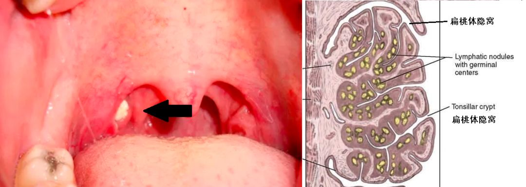 10%以上的人,扁桃体上都会长结石!