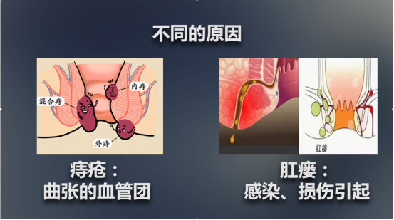 与肛瘘的区别 痔疮: 痔疮是血管性的疾病,它主要是由于静脉的回流不好