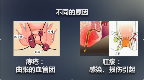 痔疮与肛瘘的区别