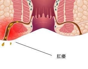 大连奥林肛肠医院：肛瘘的主要症状有哪些？