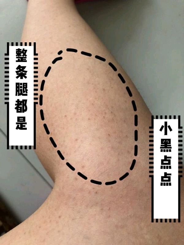 十年鸡皮肤竟然一个月就没啦?去鸡皮修复霜要火啊