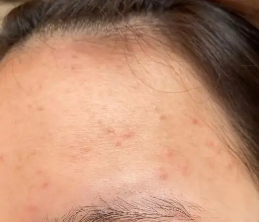 额头上长痘痘怎么办？应该注意哪些问题