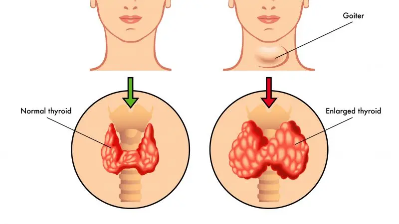 看甲状腺结节最佳治疗方法