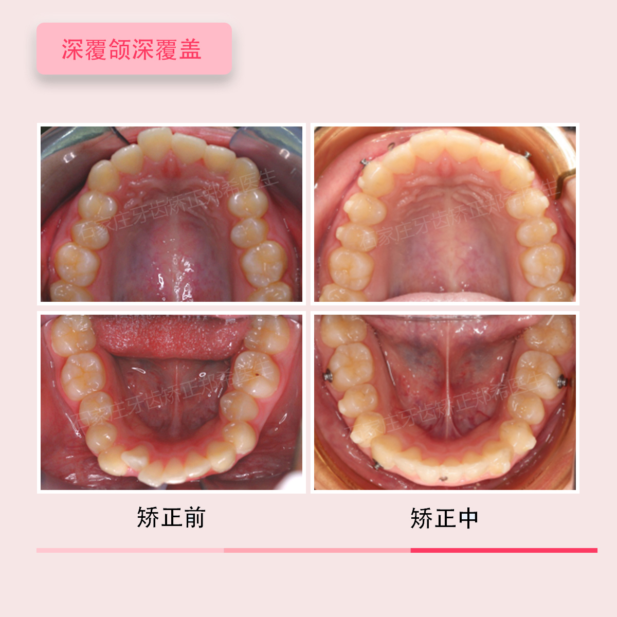 石家庄牙齿矫正郑希医生案例集:门牙对刃,深覆盖,深覆颌深覆盖的正畸