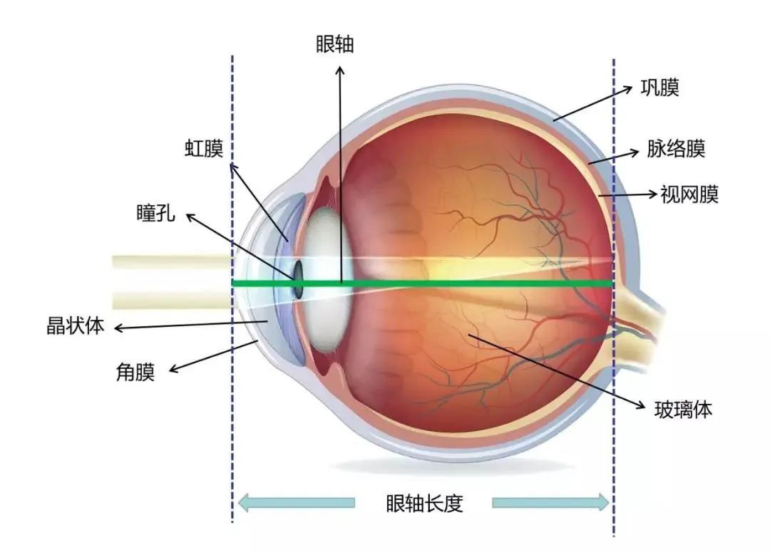 跟近视有何关联?