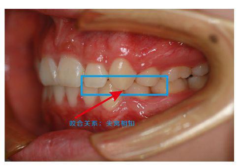 正常咬合: 上排牙齿的窝,对下排牙齿的尖,而非正常的咬合属于尖对尖