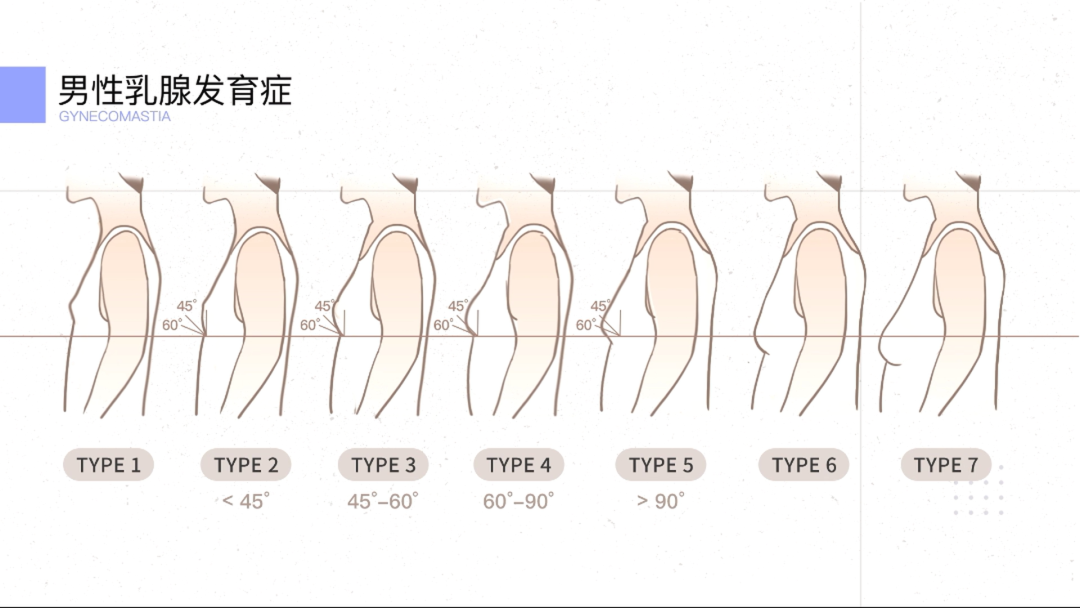 男性乳房增大是种病,叫做男性乳腺发育症.