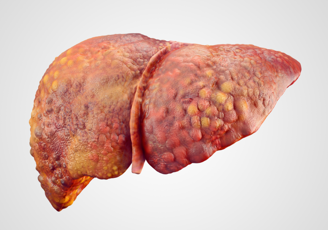 肝肿瘤如何区分良性与恶性