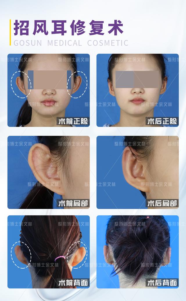 案例女生有一双招风耳是什么体验为了摆脱招风耳她做了招风耳修复手术