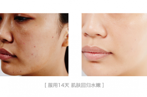 "小云朵"胶原蛋白肽使用前后肌肤对比图