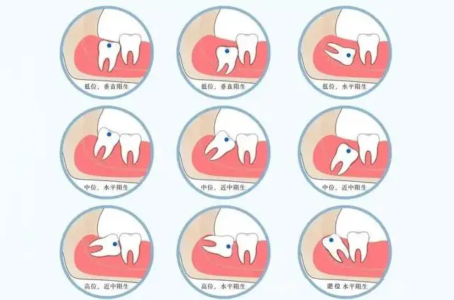 到底要不要拔智齿？