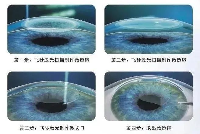 定制散光隐形最多多少度,定制散光隐形最多多少度合适