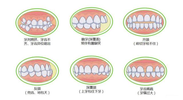 【深圳牙齿矫正科普】牙齿很小可以通过牙齿矫正改善吗?