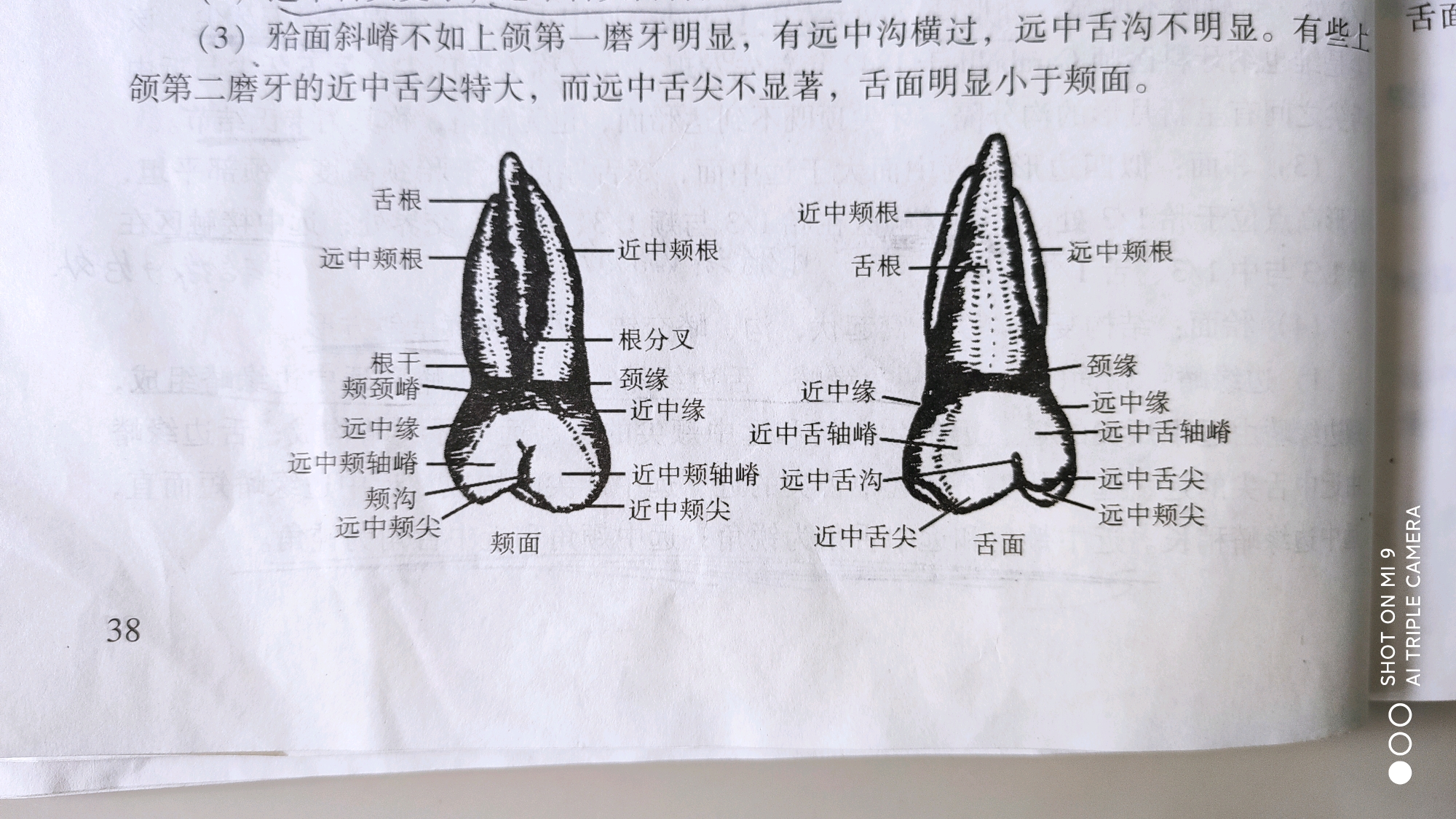 右侧上颌第二磨牙