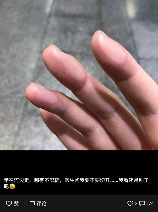 常在河边走,哪有不湿鞋.也曾一不小心"废了"四根手指.