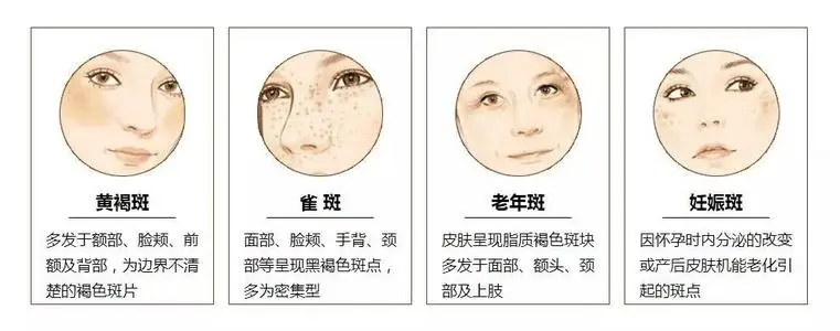 怎么祛斑最安全？怎样才能淡斑的有效方法