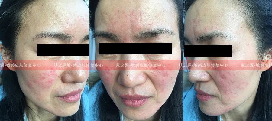 玫瑰痤疮能用壬二酸吗?壬二酸的前生今世及14个常见问题!