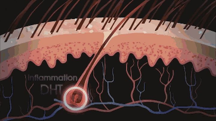 男性雄性激素过高,皮肤油脂过多,引起头皮毛囊炎,有氧运动可以降低雄