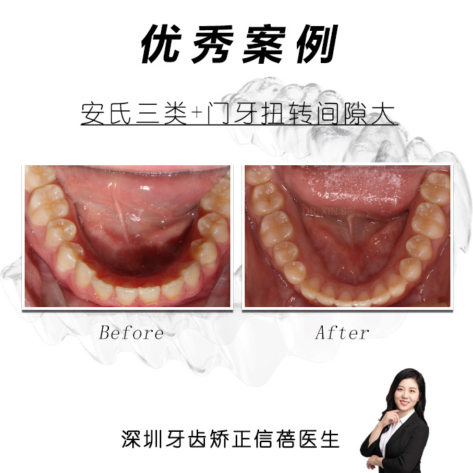 深圳牙齿矫正信蓓正畸案例集:门牙扭转间隙较大的正畸