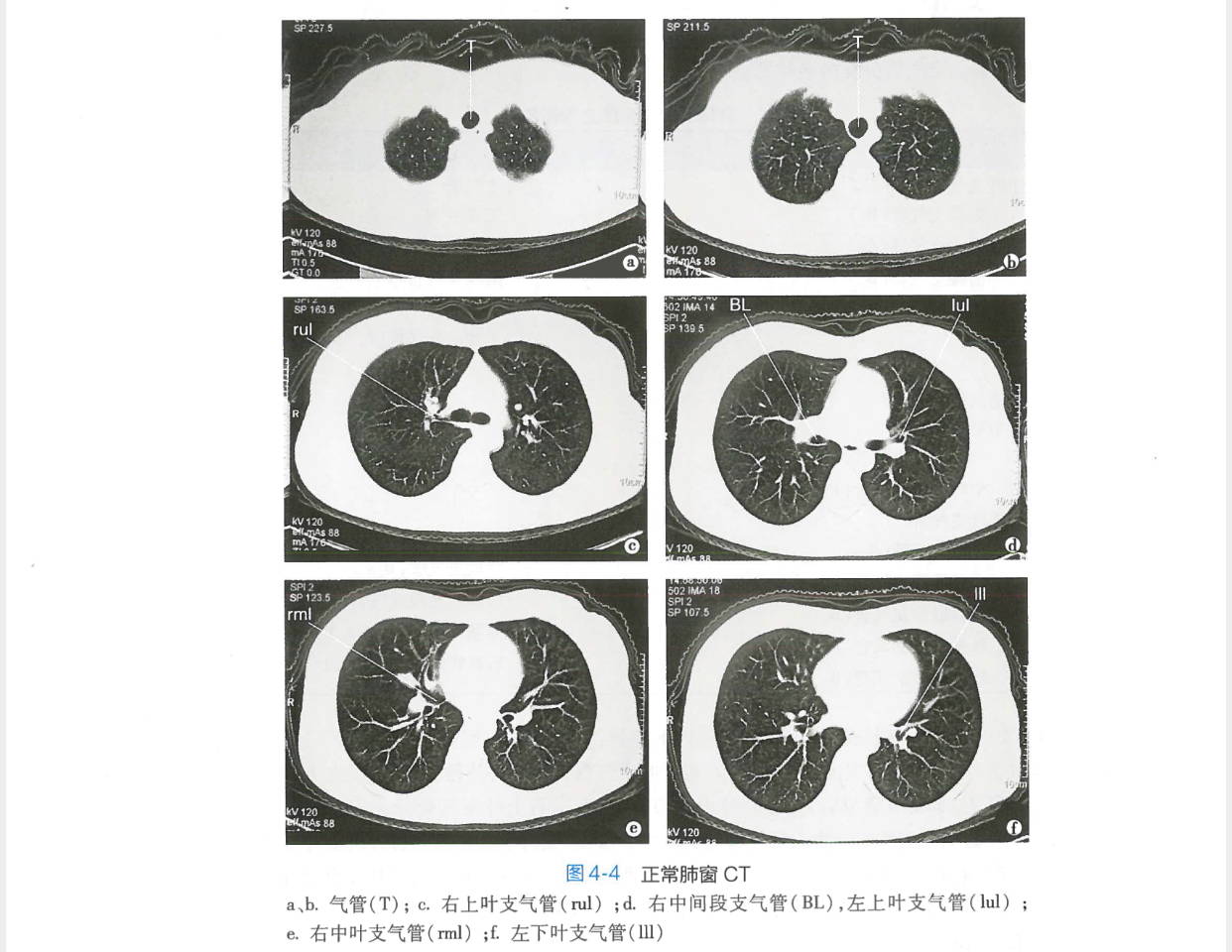 这是正常肺部ct,肺部质地较为均匀.