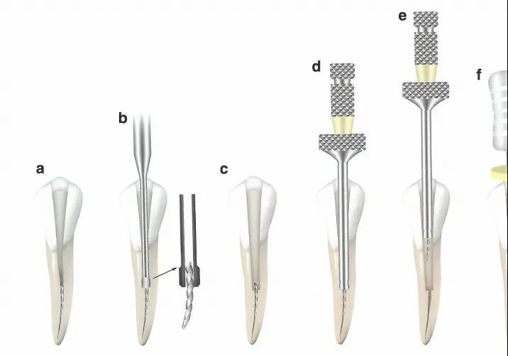 牙齿根管内显微镜下取断针根管内分离器械处理