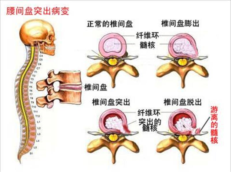 2年腰痛后屁股痛几个医生束手无策专家晚来一步就要残废了