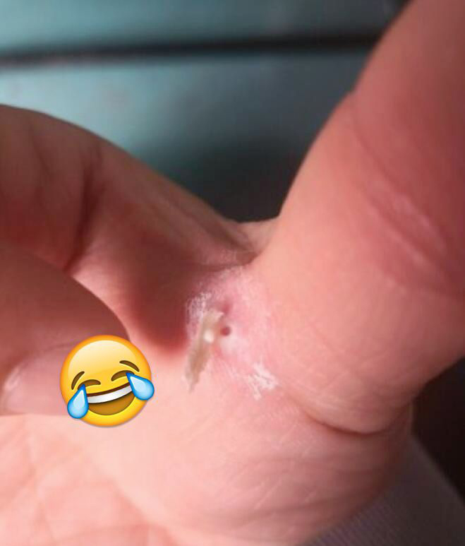 手上的鸡眼如何根治
