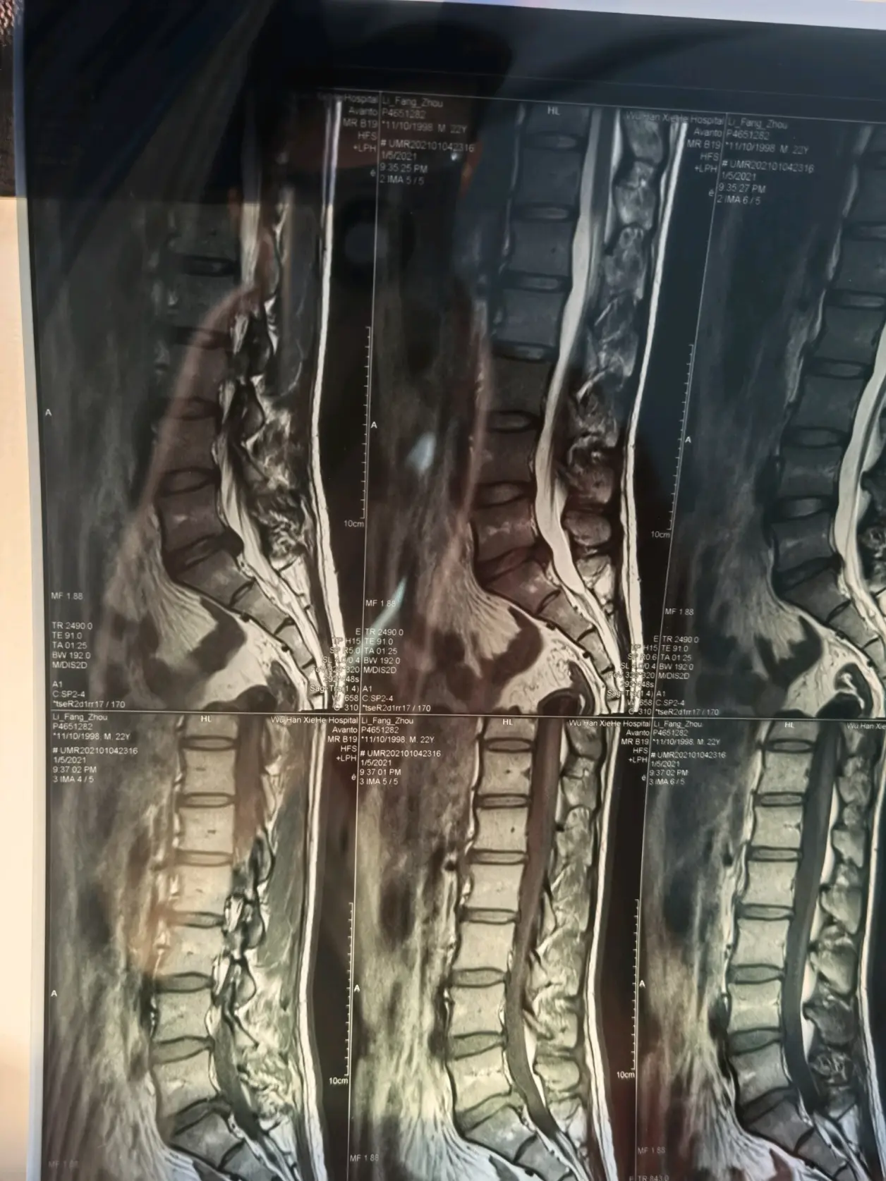 腰椎间盘突出手术经历