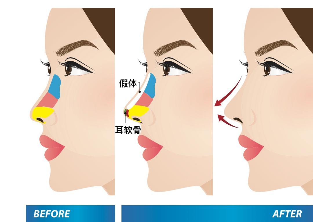 隆鼻干货你知道自己最适合什么鼻形吗隆鼻材料怎么选