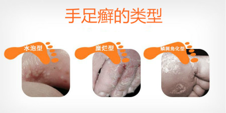 【郑州肤康皮肤科】为什么说冬季是治疗手足癣的最佳时机?