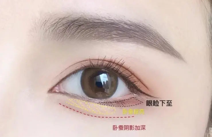 下眼睑下至术是什么？#双眼皮#