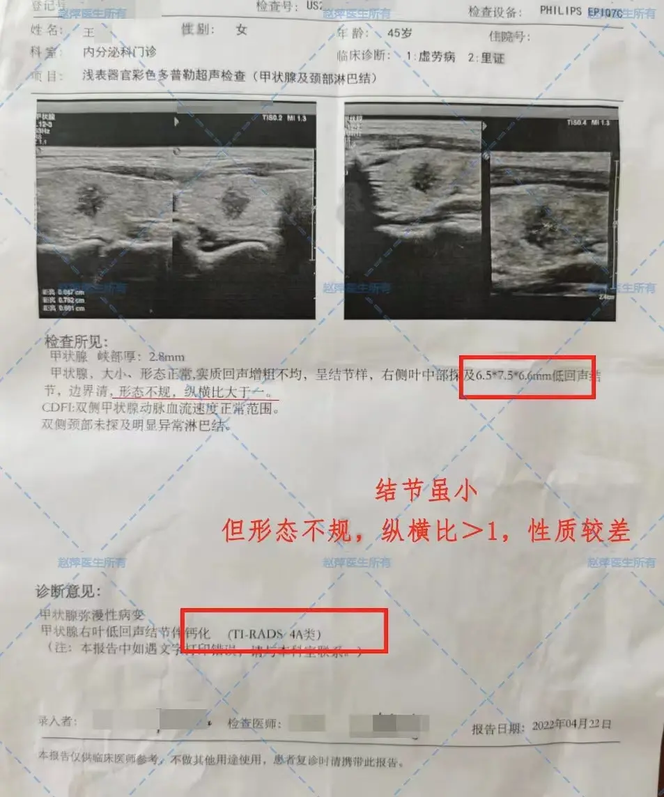 王女士，45岁，比较爱生气，易怒易燥，失眠多梦，检查出甲状腺结节4a级