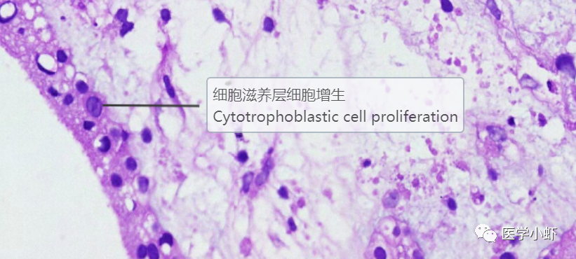 高倍镜观察〕:绒毛表面合体滋养层细胞及细胞滋养层细胞增生,绒毛