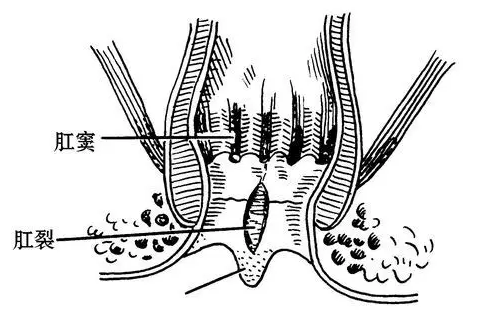 虽然没有脱垂到肛门部位外,但是也会引起肛门周围坠胀感及排便的不尽