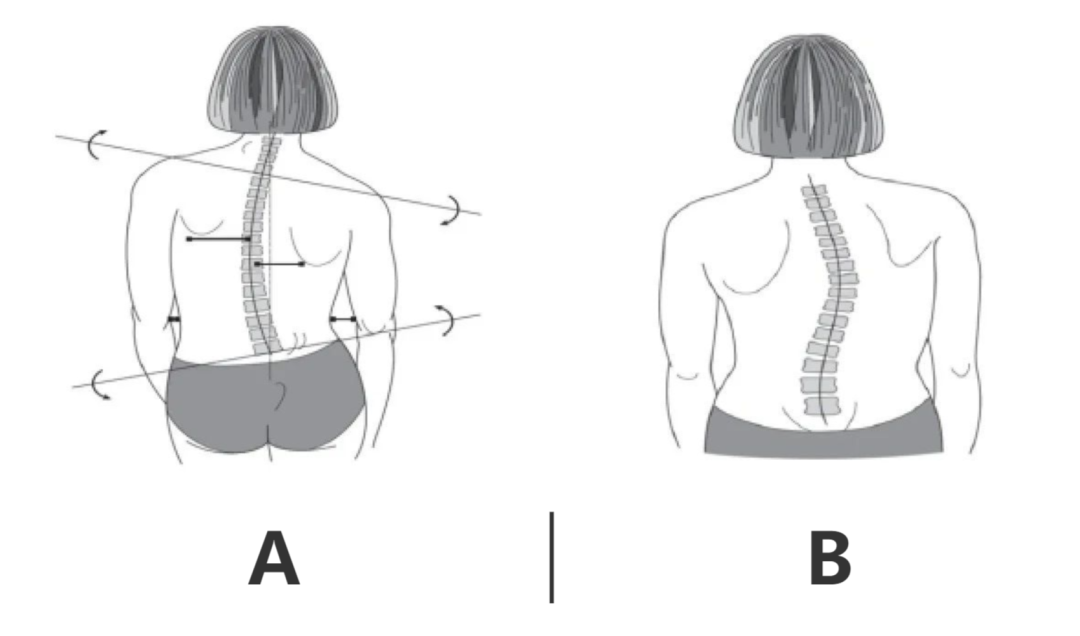如何判断是否患有脊柱侧弯检查评估