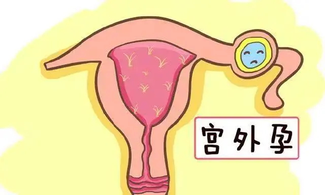 怀孕多久可以确定是不是宫外孕？