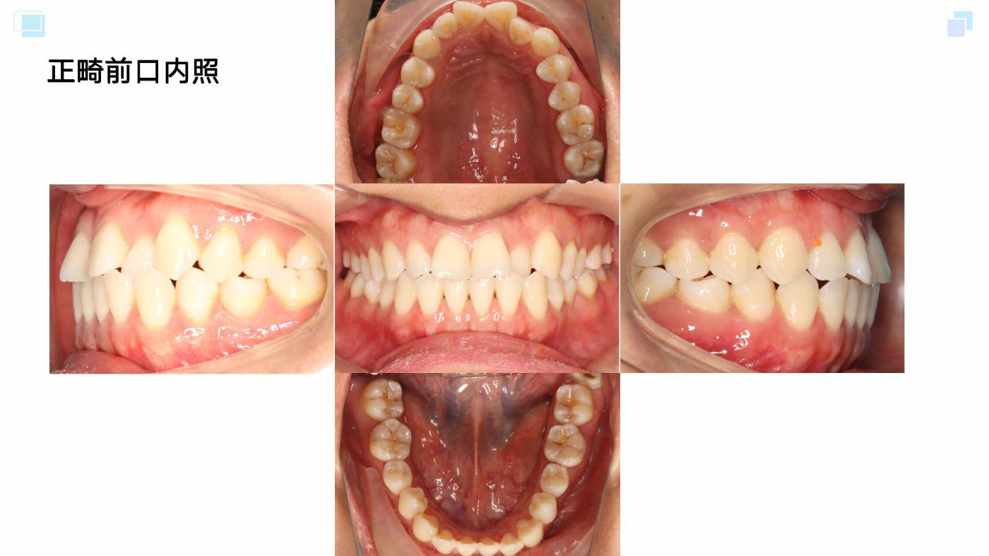 广州隐适美牙齿矫正杨露正畸案例解析:牙齿不齐及前牙部分反合的