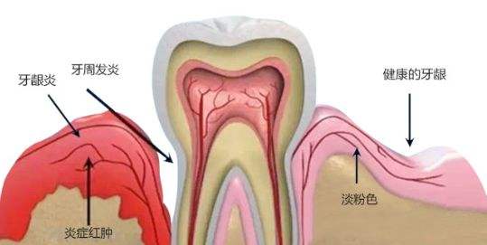 正常牙龈和牙周炎牙龈对比