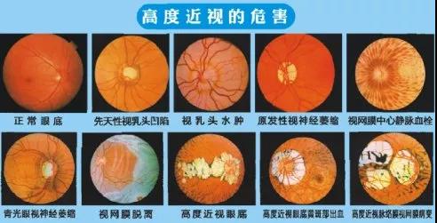 近视1.56适合多少度,近视镜1.56