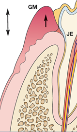 牙龈增生示意图