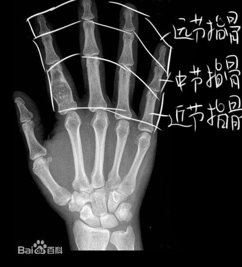 当大拇指翻转到内测的时候,尺骨和桡骨会形成交叉.