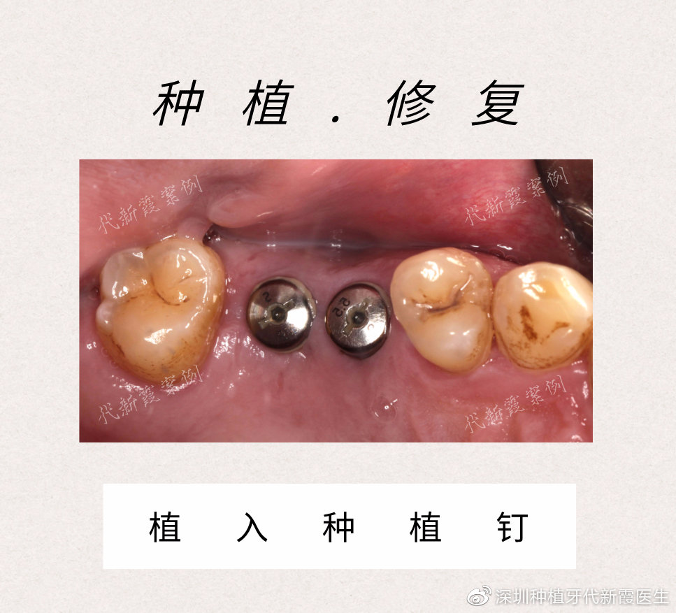 深圳种植牙案例|患者上颌磨牙缺失,导致吃饭不畅营养不良,通过微创种