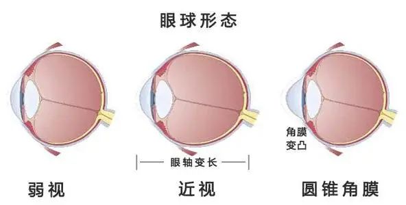 眼镜框变形了怎么矫正,眼镜框变形了怎么矫正视频