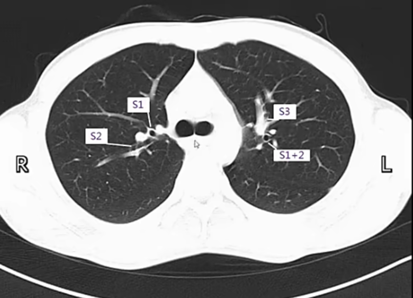 肺部ct---p1