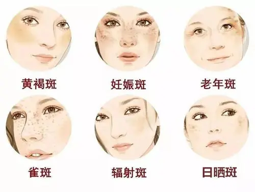 怎么淡斑最快最有效？怎样才能祛斑的有效方法