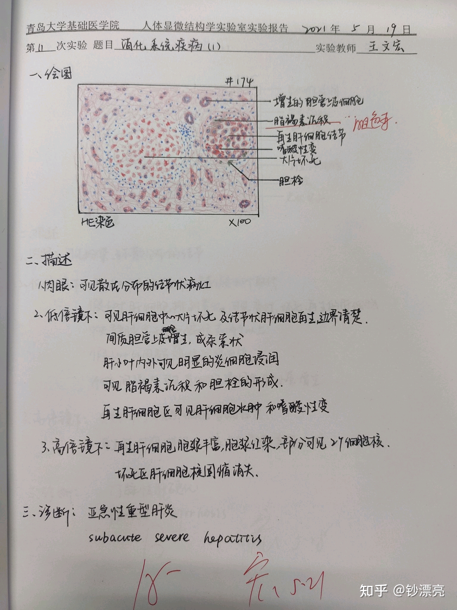 11.亚急性重型肝炎